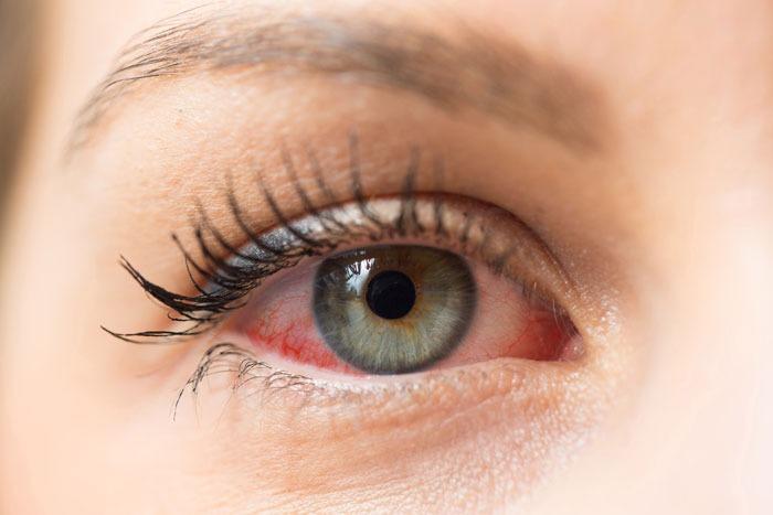 علاجات طبيعية لتخفيف التهابات العين .. تعرفوا عليها