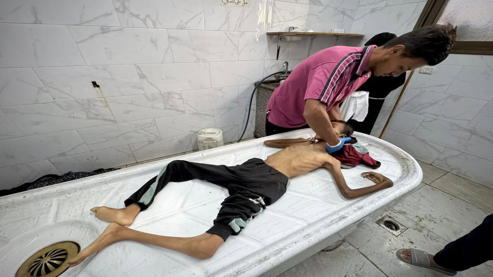  بينهم 131 طفلا.. ارتفاع ضحايا المجاعة في غزة إلى 370 شهيدا