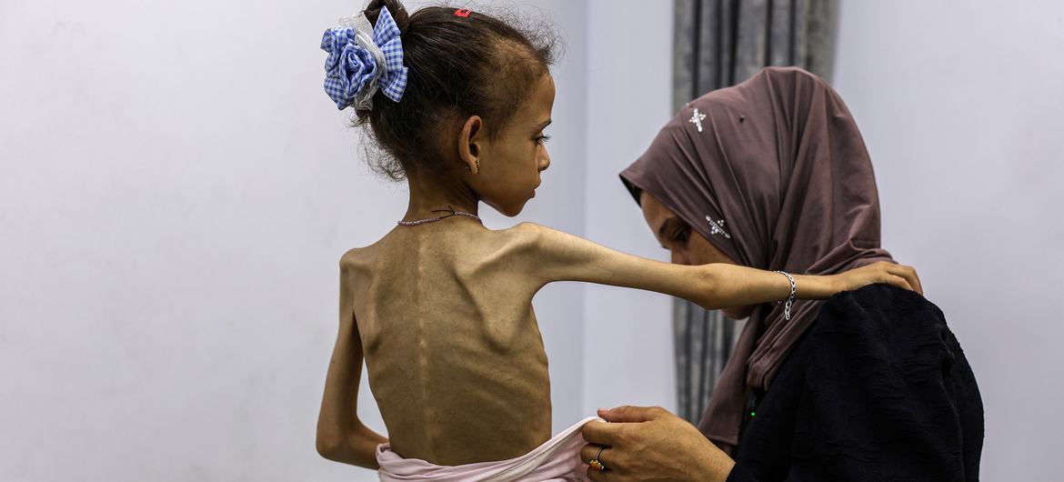 تسجيل 3 وفيات جديدة بغزة نتيجة سوء التغذية والمجاعة  