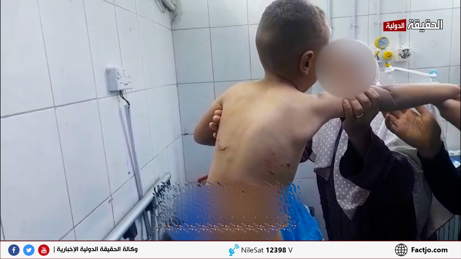 كلاب ضالة تنهش طفلًا بالمفرق.. والجهات المعنية غائبة - صور
